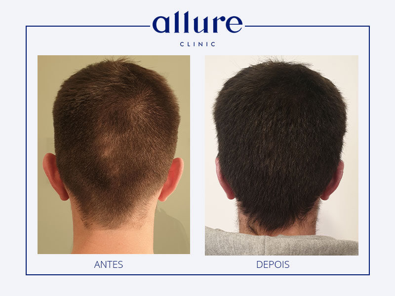 Cirurgia às orelhas bilateral - Clinica no Porto 02