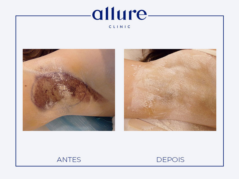 Underarm Sweat Treatment miradry allure clinic clinica porto 01