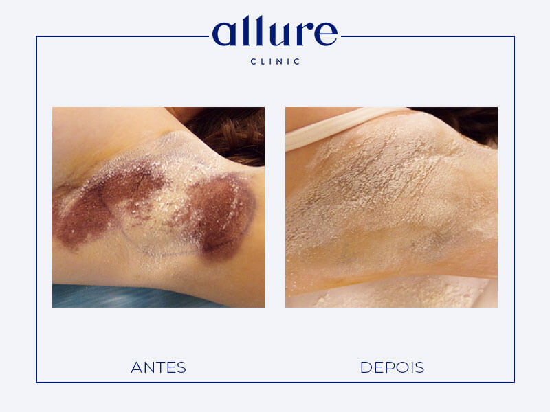 Underarm Sweat Treatment miradry allure clinic clinica porto 02