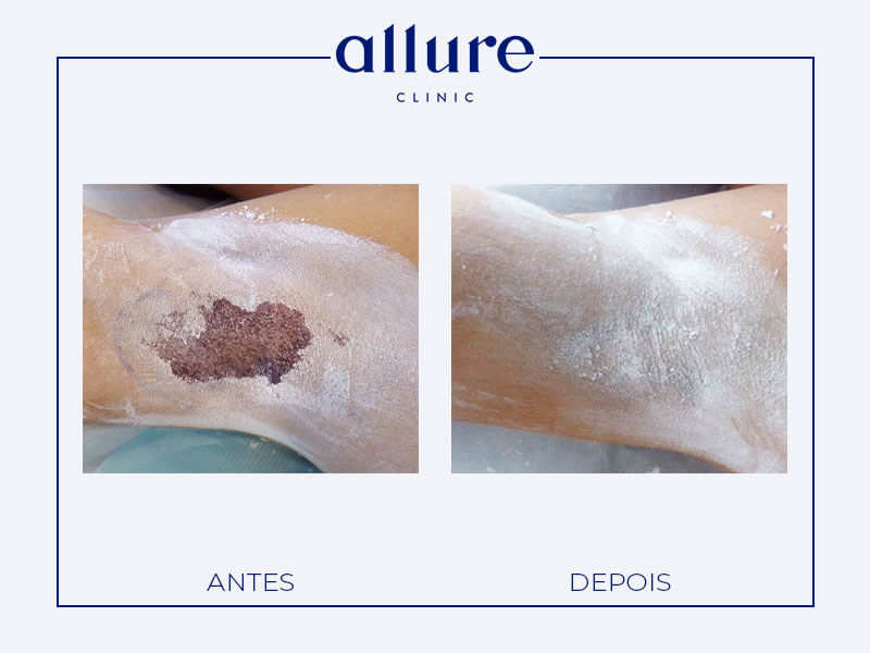 Underarm Sweat Treatment miradry allure clinic clinica porto 03