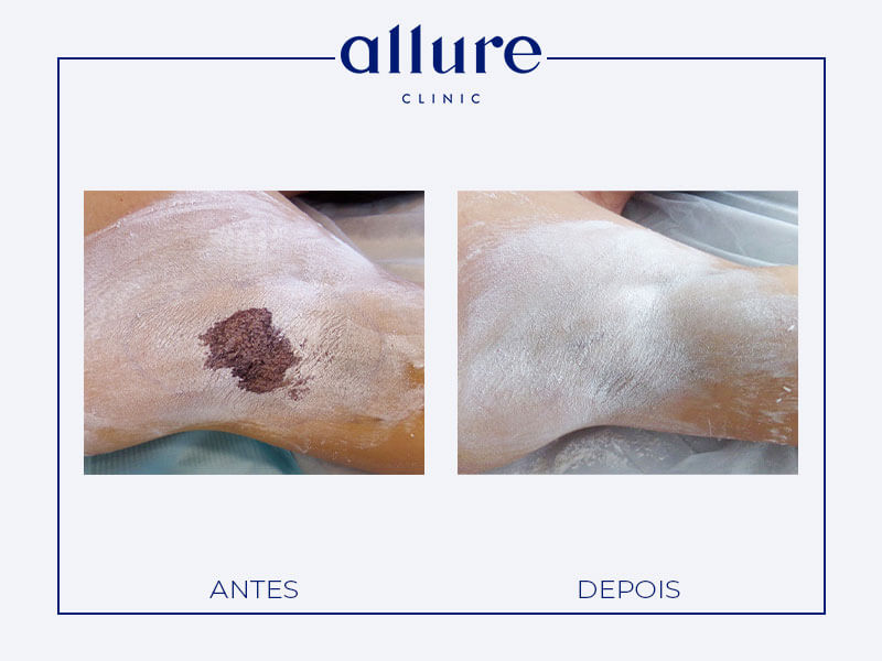 Underarm Sweat Treatment miradry allure clinic clinica porto 04