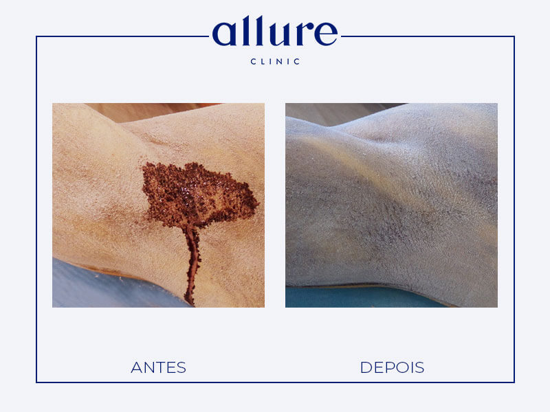 Underarm Sweat Treatment miradry allure clinic clinica porto 05