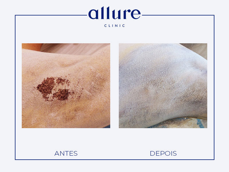 Underarm Sweat Treatment miradry allure clinic clinica porto 06