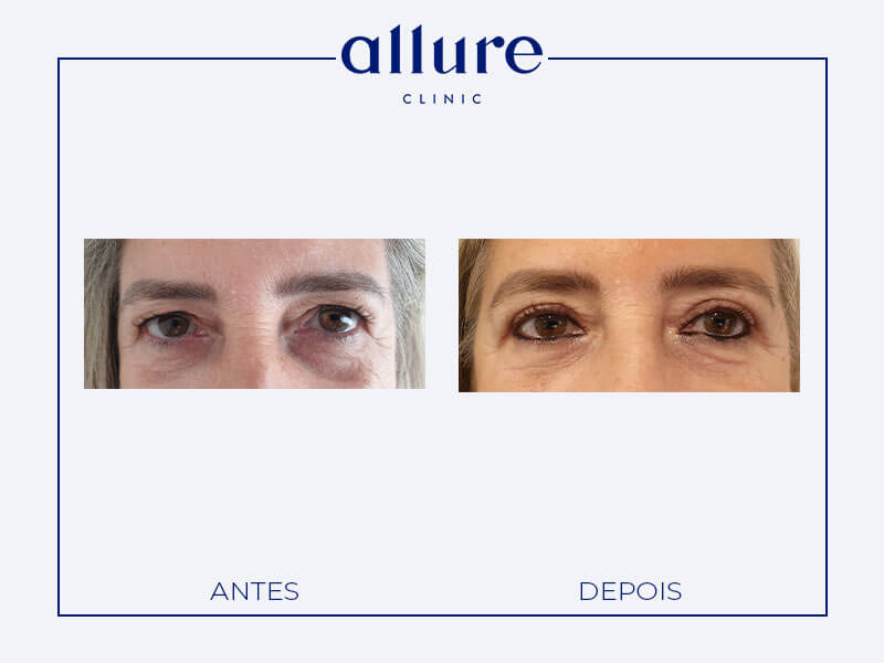 Blefaroplastia - allure clinic no porto - cirurgia plástica - dra carolina andresen - caso-01- frente