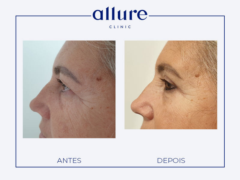 Blefaroplastia - allure clinic no porto - cirurgia plástica - dra carolina andresen - caso-01- perfil