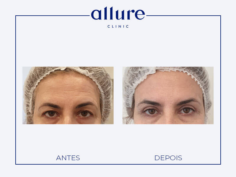 Blefaroplastia - allure clinic no porto - cirurgia plástica - dra carolina andresen - caso-02- frente