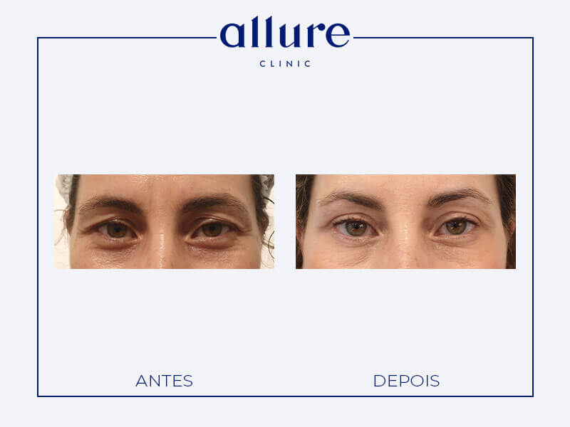 Blefaroplastia - allure clinic no porto - cirurgia plástica - dra carolina andresen - caso-03- frente
