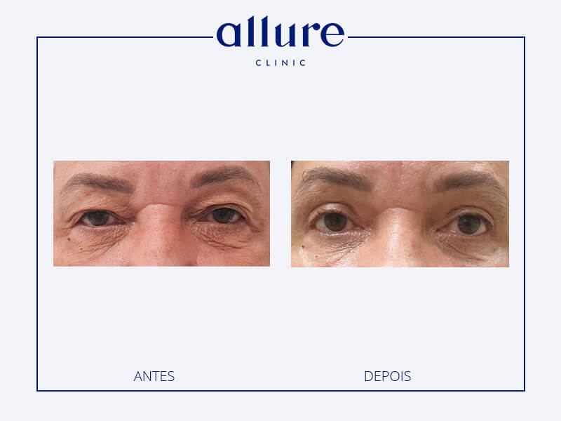 Cirurgia aos olhos - Allure Clinic -02