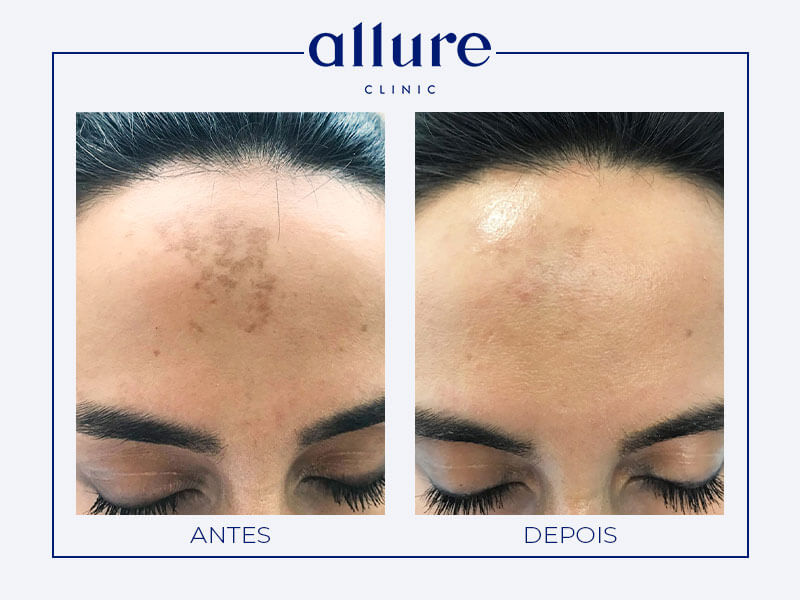 Dermatologia - Laser Antes do tratamento IPL (luz pulsada intensa) - Allure Clinic no Porto - Caso Antes e Depois - 03