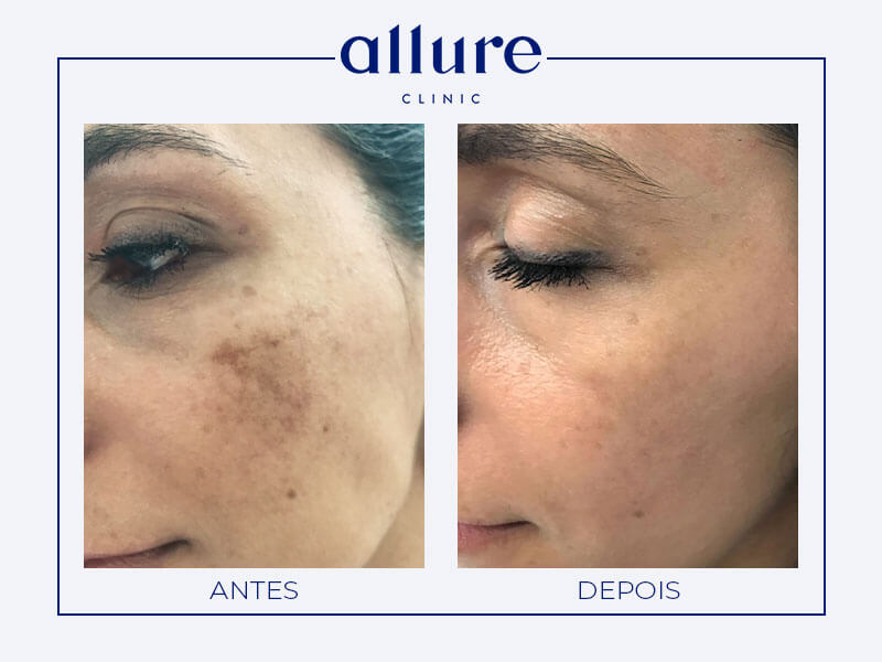 Dermatologia - Laser Antes do tratamento IPL (luz pulsada intensa) - Allure Clinic no Porto - Caso Antes e Depois - 05