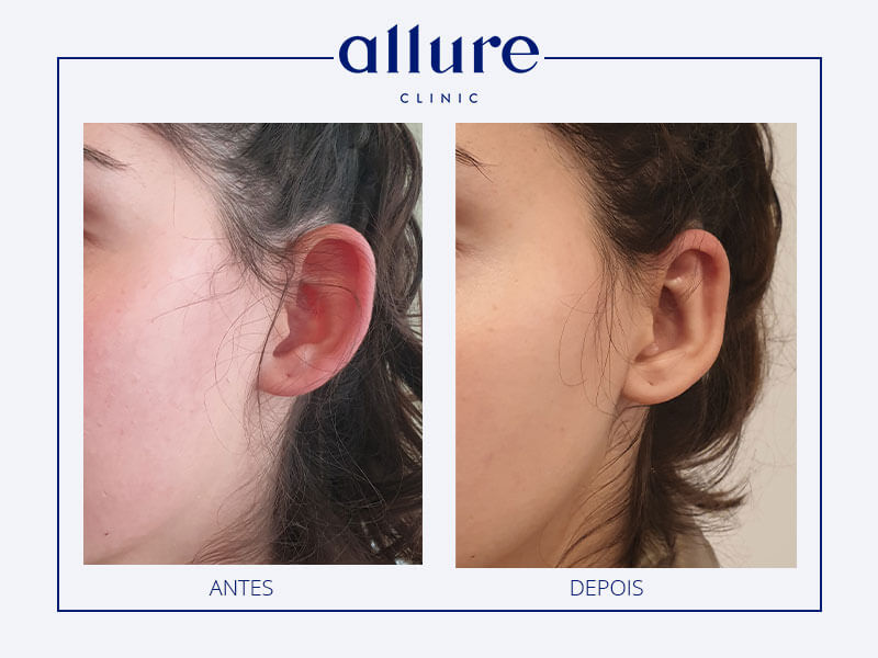 Cirurgia às orelhas aladas bilateral - Clinica no Porto 01