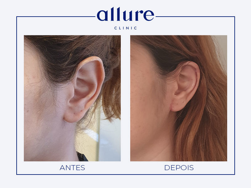 Otoplastia - Allure Clinic no Porto - Dra. Carolina Andressen - Caso 01