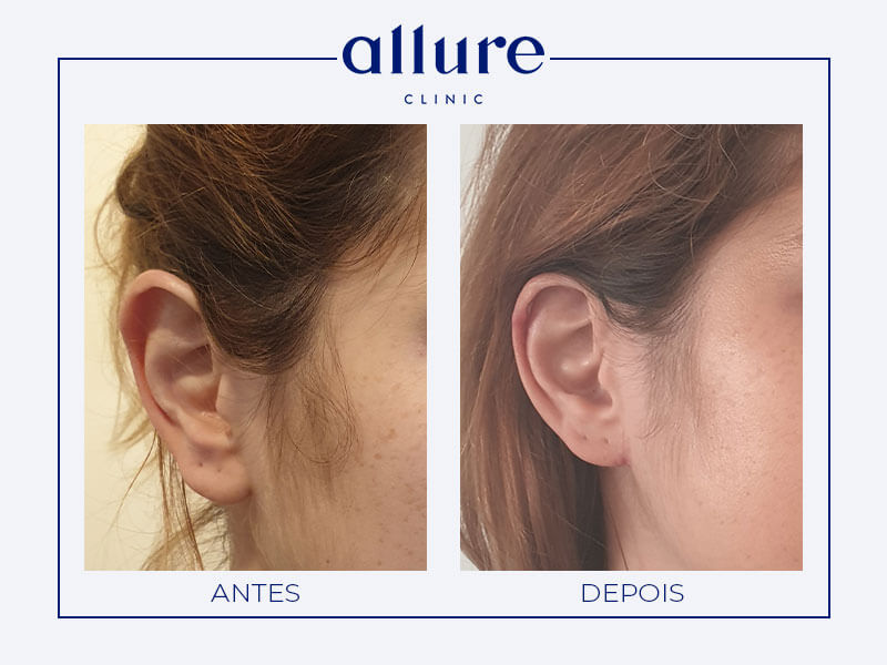 Otoplastia - Allure Clinic no Porto - Dra. Carolina Andressen - Caso 02