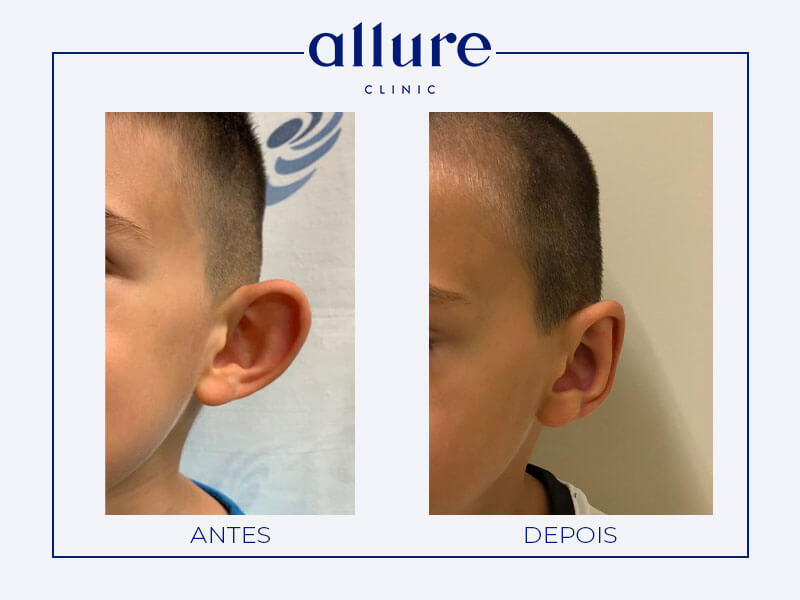 Cirurgia de redução nas orelhas - Allure Clinic no Porto - Dra. Carolina Andressen - Orelhas aladas - Caso 01