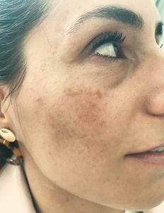 before-laser-lady