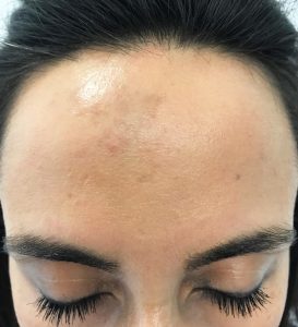 laser-lady-after