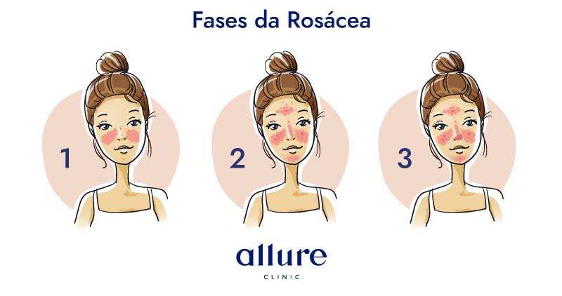 allure-rosacea