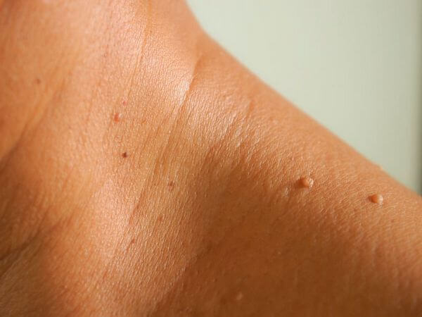 fibroma pendulo