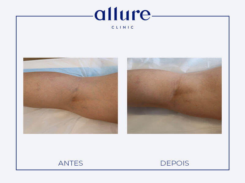 tratamento varizes antes depois clacs laser escleroterapia - clinica porto 08
