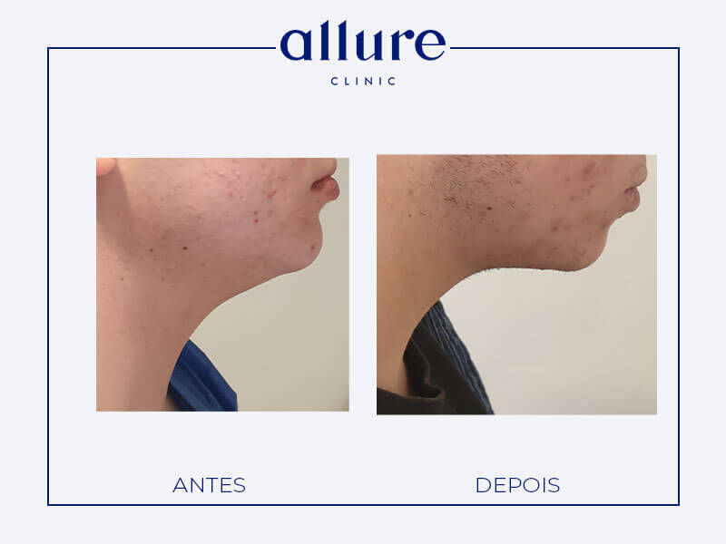Cervicofacial Lifting - Allure Clinic in Porto - Plastic Surgery - Dr. Carolina Andresen - Case 02 - Profile