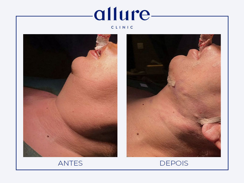 Cervicofacial Lifting - Allure Clinic in Porto - Plastic Surgery - Dr. Carolina Andresen - Case 01 - Profile