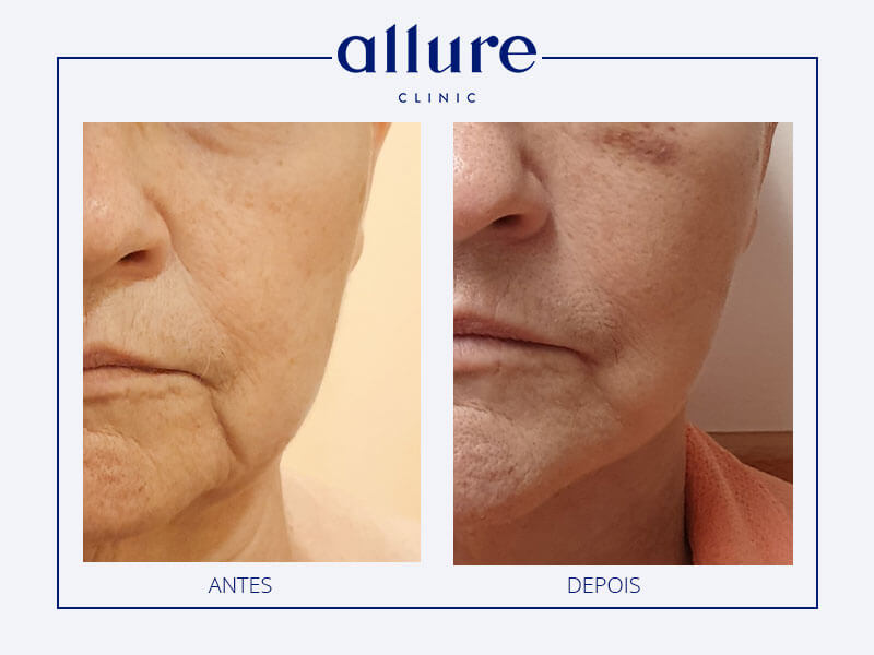 Cervicofacial lifting clinic in Porto 01