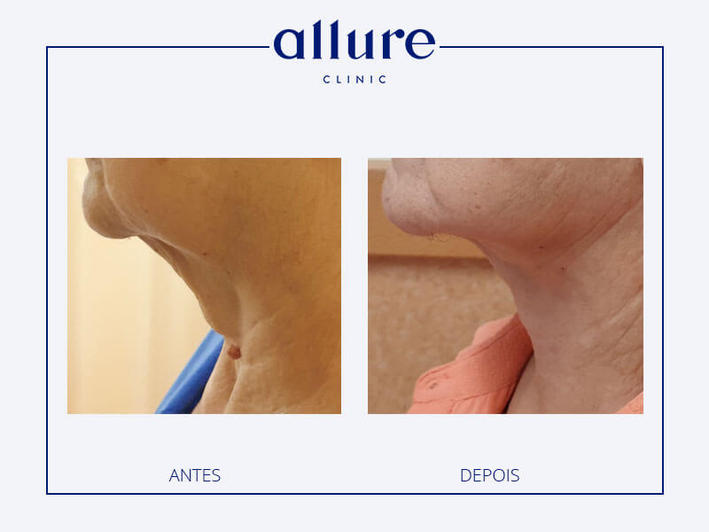 Cervicofacial lifting clinic in Porto 01