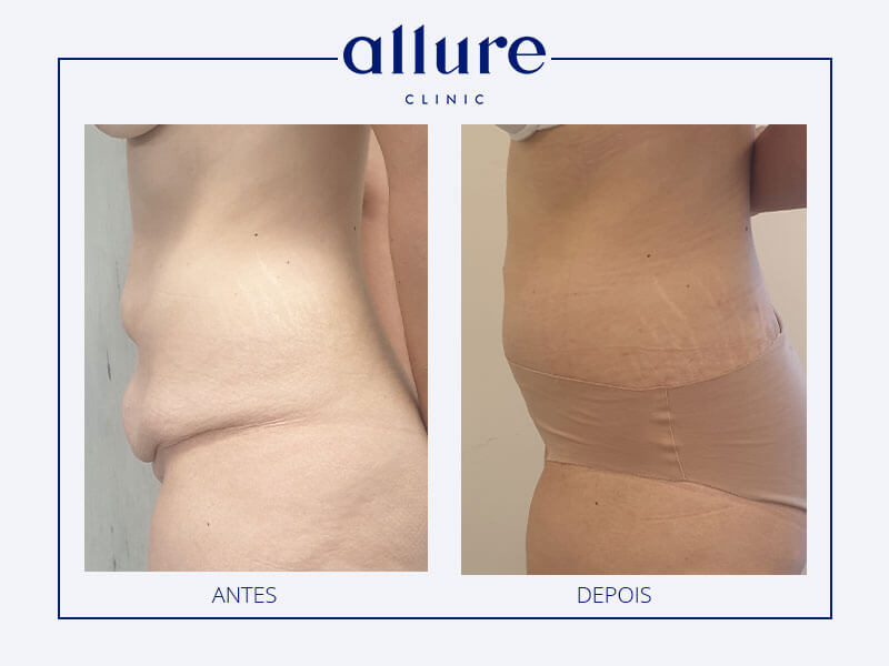 abdominoplasty-allure-clinic-02-03