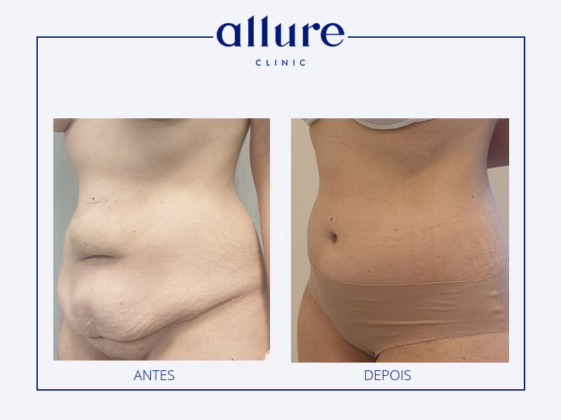 abdominoplasty-allure-clinic-02-02