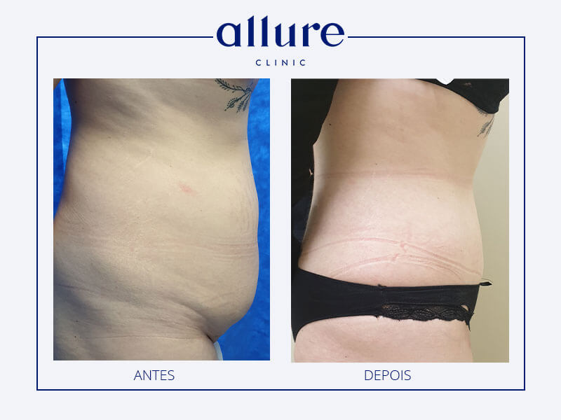 Lipoabdominoplasty with umbilical transposition and plication of the rectus abdominis sheath