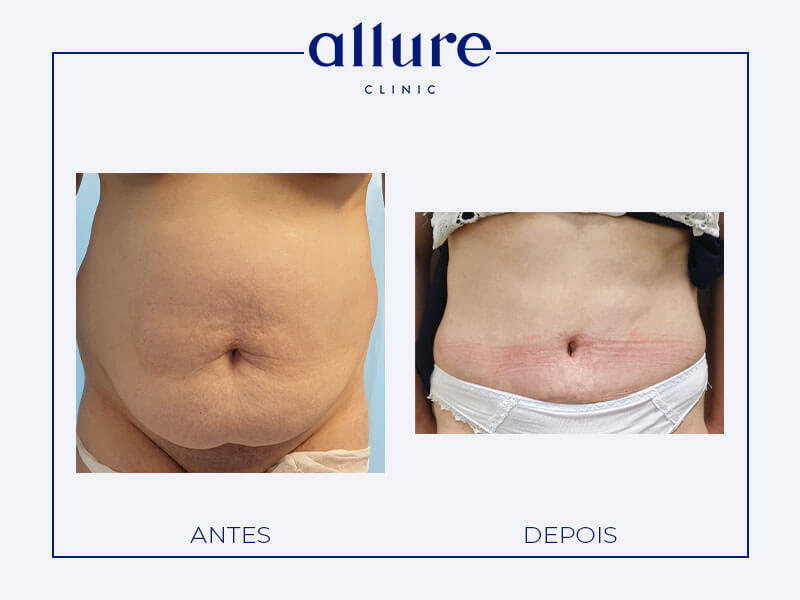 Abdominoplasty - Allure Clinic in Porto - Plastic Surgery - Dr. Carolina Andresen - Case 01 - Front