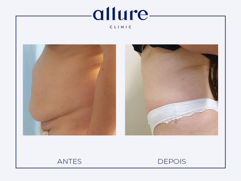 Abdominoplasty - Allure Clinic in Porto - Plastic Surgery - Dr. Carolina Andresen - Case 01 - Profile