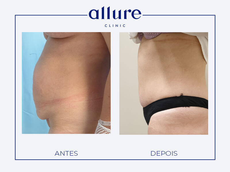 Abdominoplasty - Allure Clinic in Porto - Plastic Surgery - Dr. Carolina Andresen - Case 02 - Profile