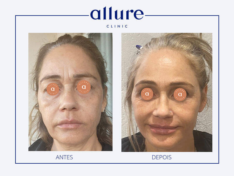 Cervicofacial lifting, upper blepharoplasty