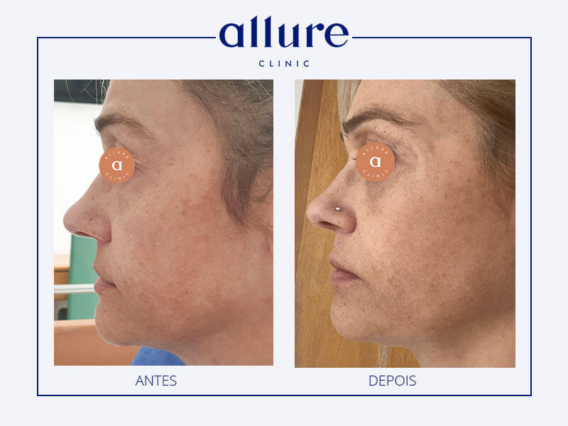 Cervicofacial lifting, upper blepharoplasty and bilateral subciliary lower blepharoplasty 02