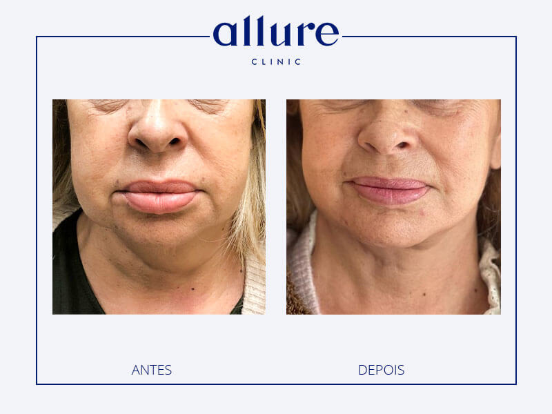 Surgery: Cervicofacial lifting with lipofilling, Anesthesia: General, Hospitalization: 1 night