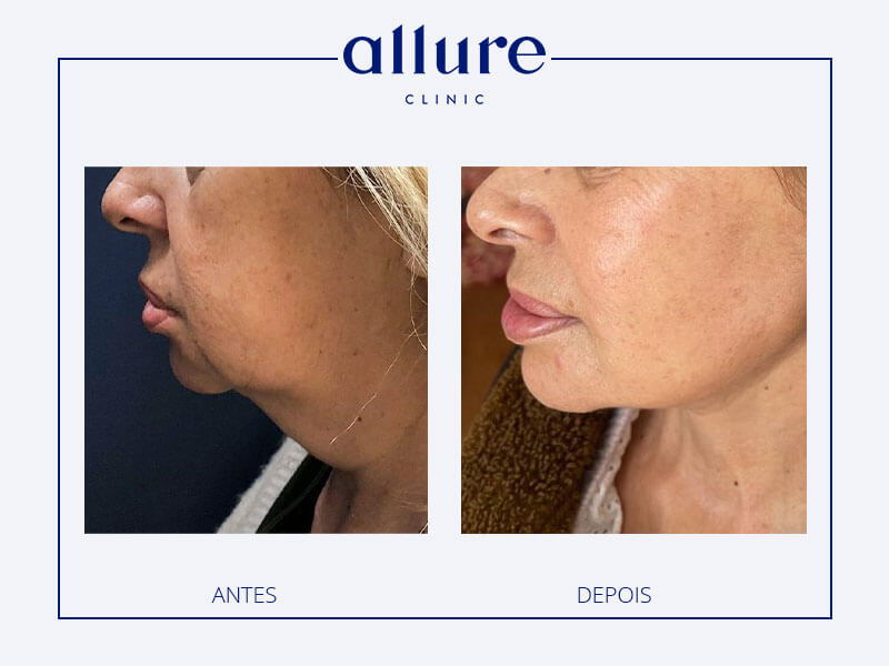 Surgery: Cervicofacial lifting with lipofilling, Anesthesia: General, Hospitalization: 1 night