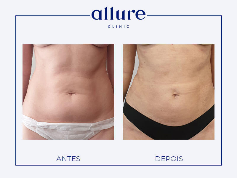 Liposuction - Allure Clinic in Porto - Plastic Surgery - Dr. Carolina Andresen - Case 01 - Front