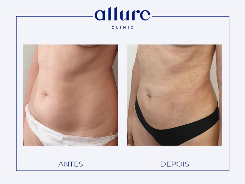 Liposuction - Allure Clinic in Porto - Plastic Surgery - Dr. Carolina Andresen - Case 01 - Profile