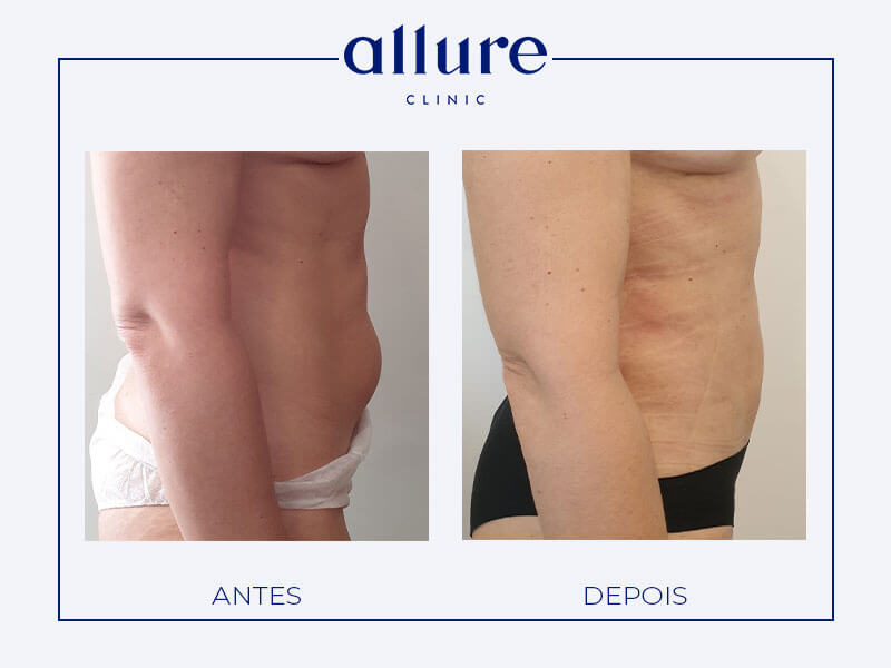 Liposuction - Allure Clinic in Porto - Plastic Surgery - Dr. Carolina Andresen - Case 01 - Side