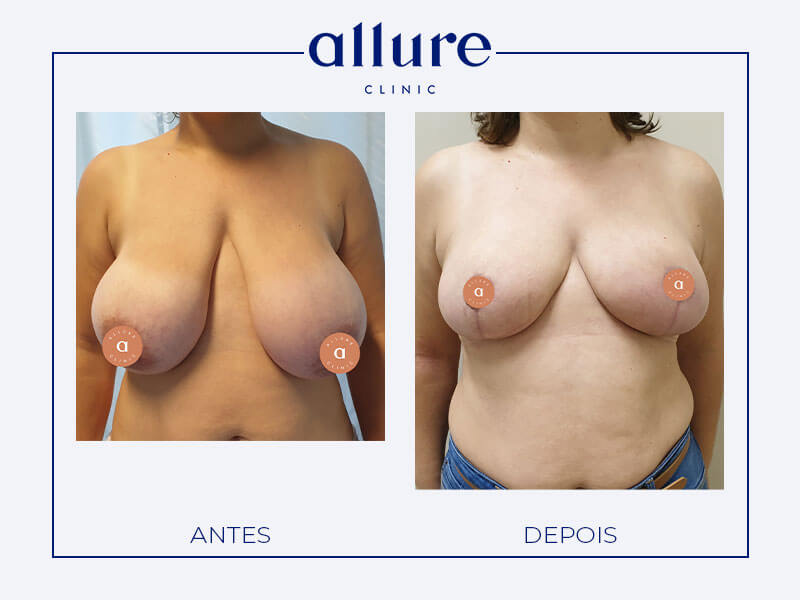 Mamoplastia de redução - Allure Clinic Porto - Dra. Carolina Andressen- Caso 01 Frente