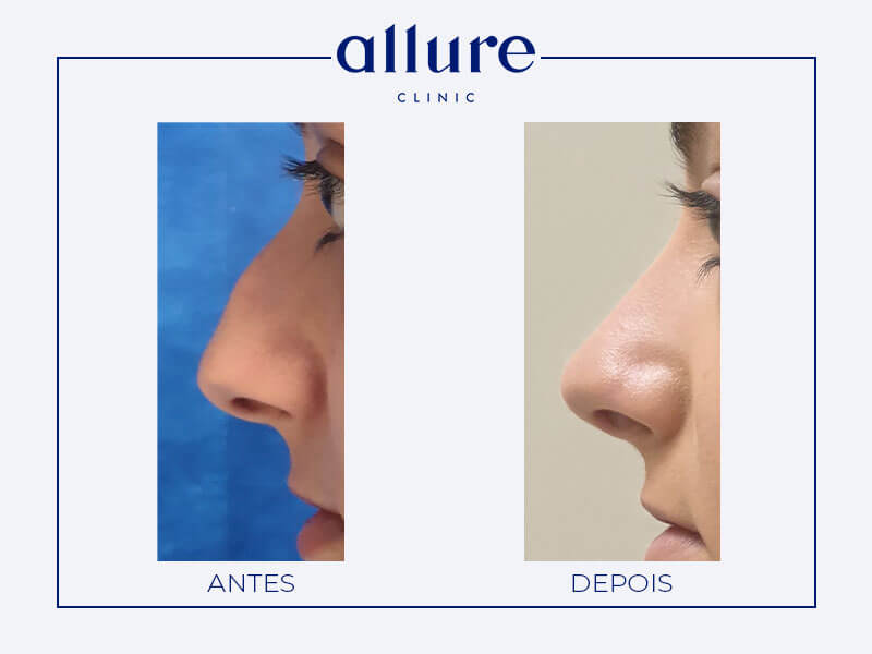 Rhinoplasty - Allure Clinic in Porto - Plastic Surgery - Dr. Carolina Andresen - Case 01 - Profile