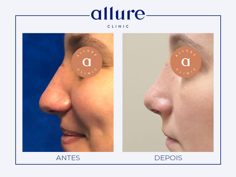 Rhinoplasty - Allure Clinic in Porto - Plastic Surgery - Dr. Carolina Andresen - Case 02 - Profile