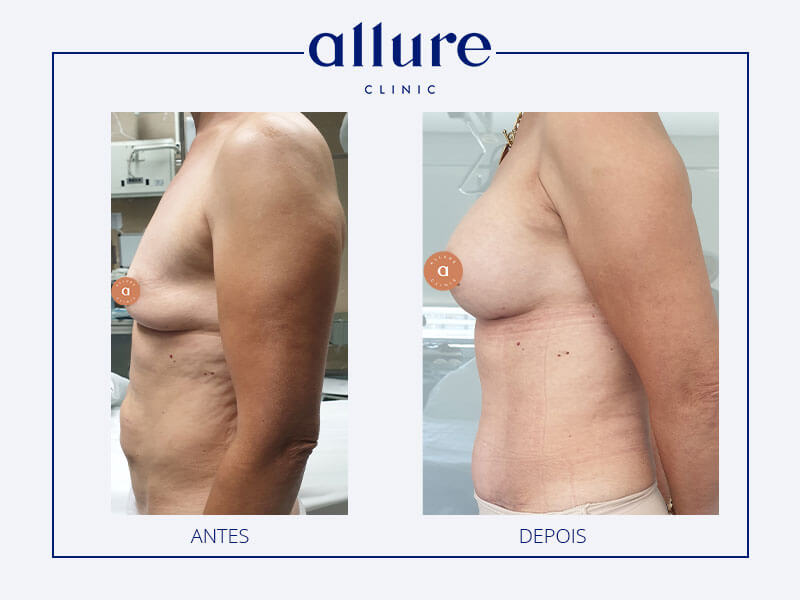 mommy makeover cirurgia de remodelação corporal após a gravidez antes depois allure clinic clinica porto 03