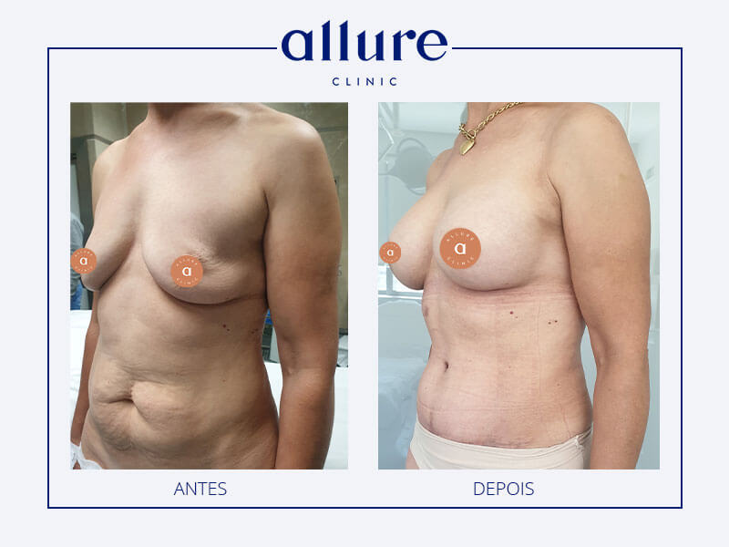 mommy makeover cirurgia de remodelação corporal após a gravidez antes depois allure clinic clinica porto 01